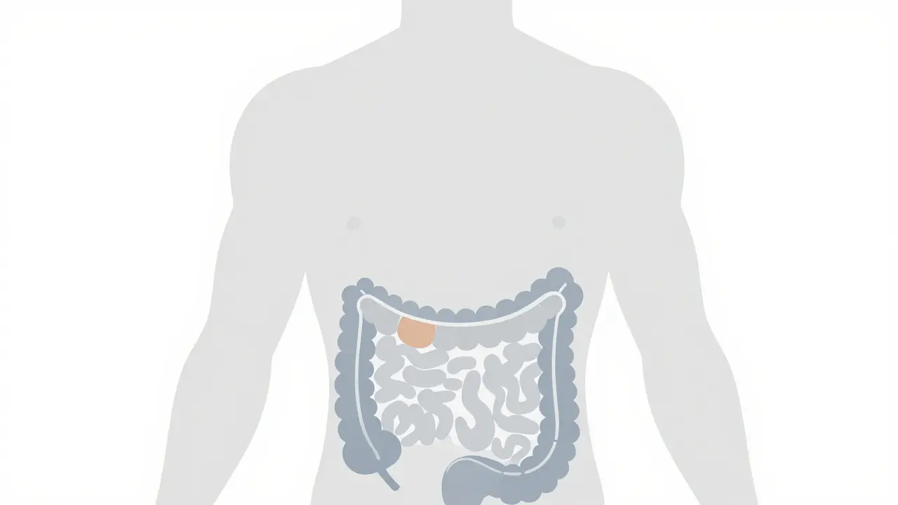 Diverticulitis: Understanding Inflamed Pouches and Modern Treatment Approaches